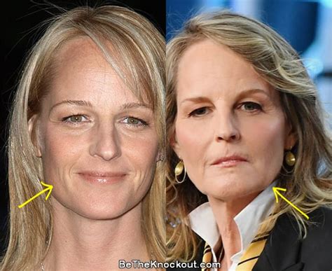 helen hunt surgery|helen hunt actress face lift.